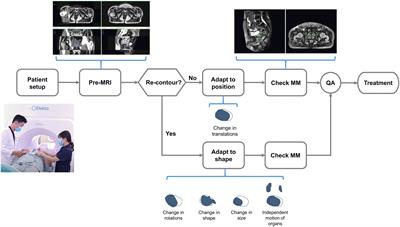 Optimal planning target margin for prostate radiotherapy based on interfractional and intrafractional variability assessment during 1.5T MRI-guided radiotherapy